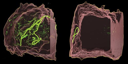 The tumor on the right with few nerves remains localized; the one on the left with many more has spread.