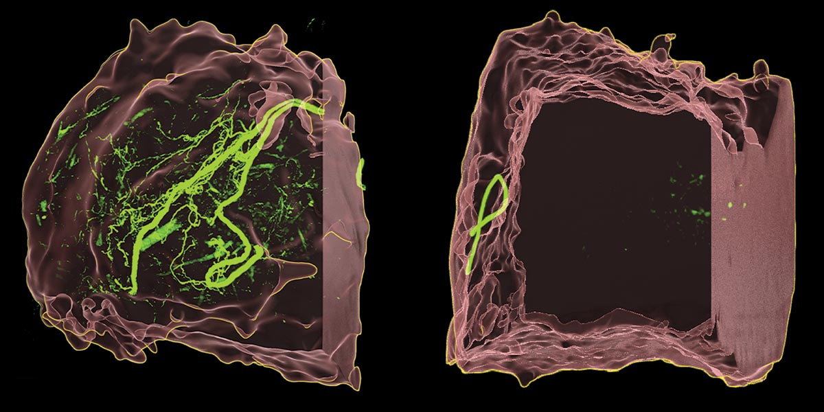 Sensory nerves help cancer spread