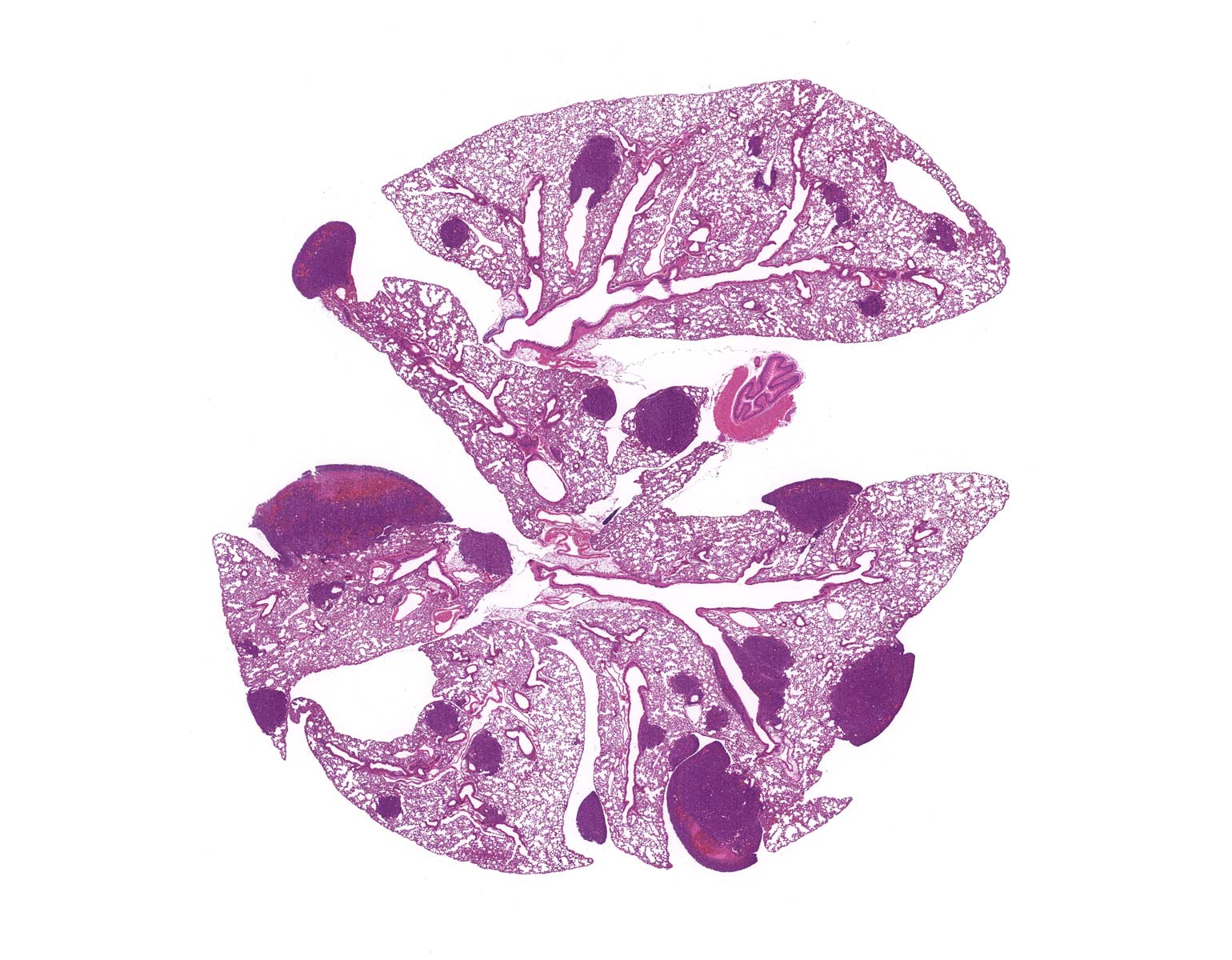 Is metastasis a hereditary disorder?